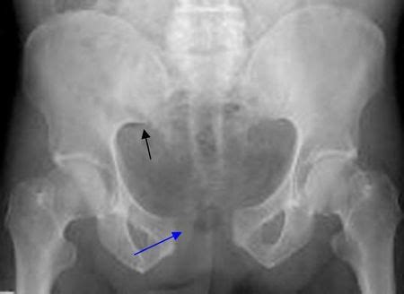 Solana: OpenBook vs OpenBookv2
